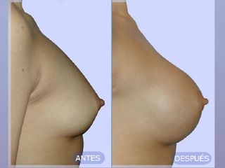 Mamoplastia de aumento