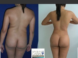 Gluteoplastia