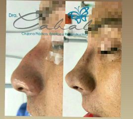 Rinoplastia