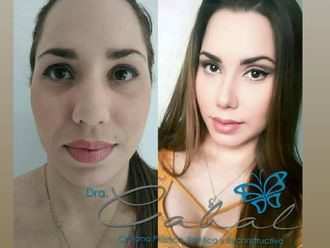 Rinoplastia - 647232