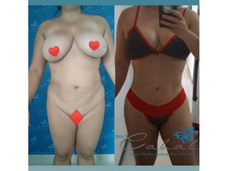Lipoescultura
