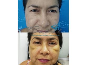 Blefaroplastia - 647668