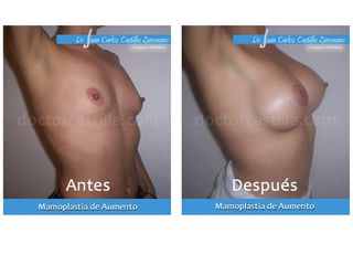 Mamoplastia de aumento