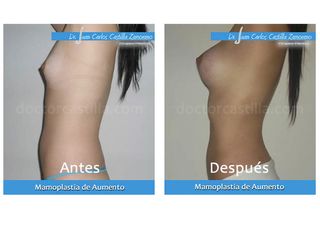 Mamoplastia de aumento