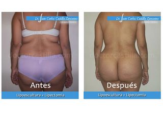 Lipoescultura