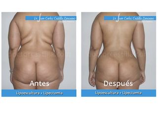 Lipoescultura y lipectomía