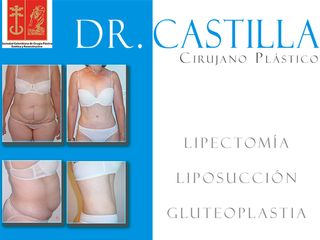 Cambio extremo en Cirugía Plástica-Dr. Castilla Cali-Colombia..jpg