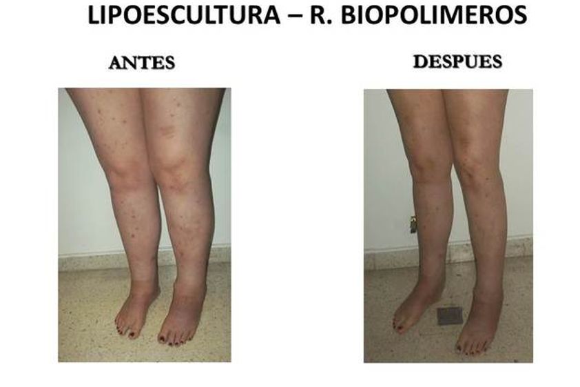 Lipoescultura antes y después - 547049