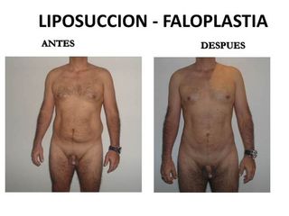 Fotos faloplastia-alargamiento-engrosamiento y marcación abdominal