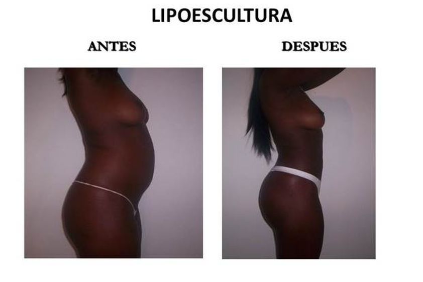 Lipoescultura antes y después - 547335