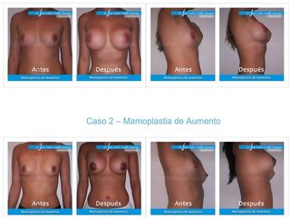 Mamoplastia de aumento