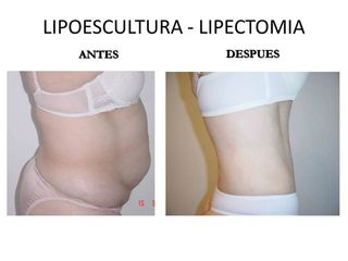 Lipectomía-Tummy tuck-Dermolipectomía-Cambio Extremo
