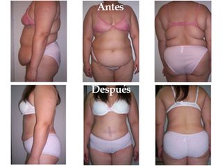 Liposucción