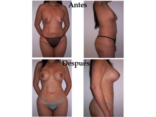 Mamoplastia de aumento