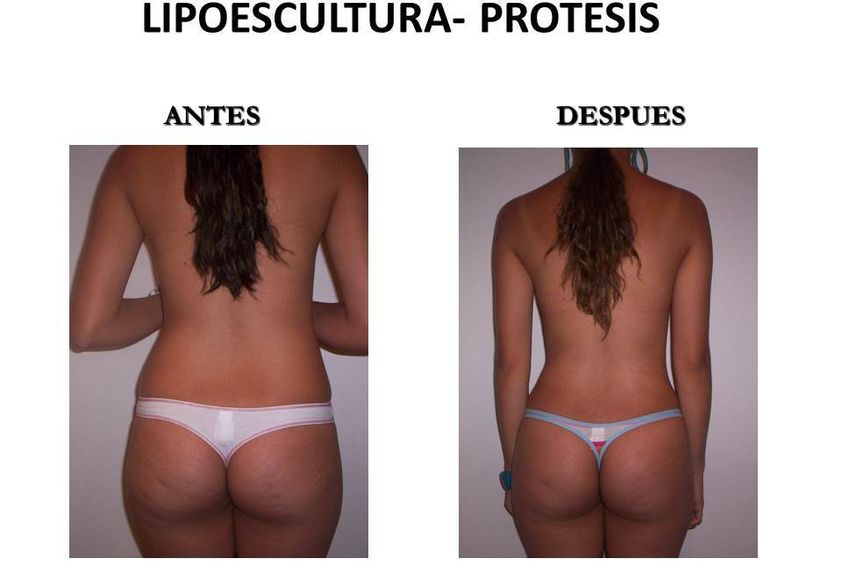 Gluteoplastia antes y después - 644717