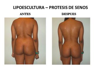 Liposucción de espalda y cintura