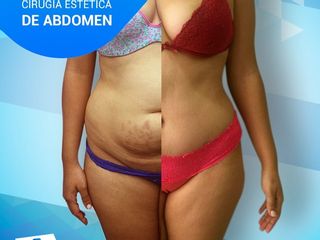 Antes y despues de abdominoplastia