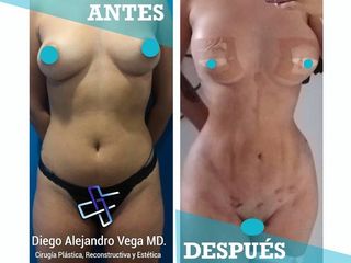 lipo 4D