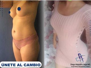 lipo 4D