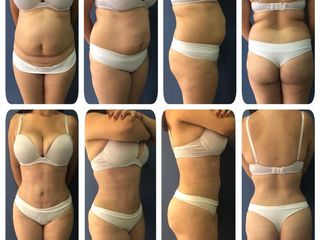 lipoabdominoplastia