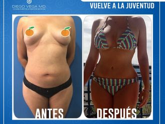 Abdominoplastia - 661268