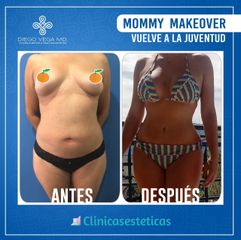Antes y despues de lipabdominoplastia y mamoplastia