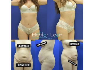 Abdominoplastia