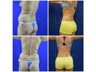 Lipoescultura