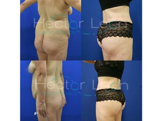 Abdominoplastia