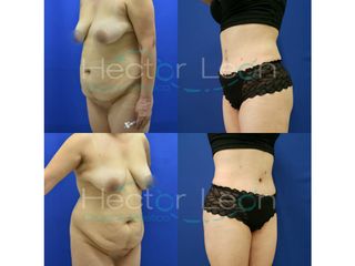 Abdominoplastia