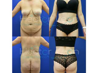 Abdominoplastia