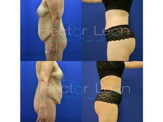 Abdominoplastia y Gluteoplastia
