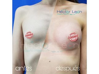 Mamoplastia de aumento