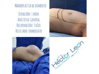 Mamoplastia de aumento - Dr. Héctor Guillermo León Higuera