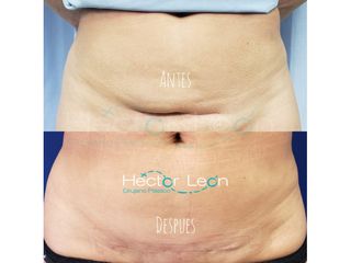 Abdominoplastia - Dr. Héctor Guillermo León Higuera
