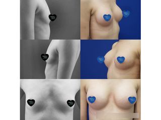 Mamoplastia de aumento - Dr. Héctor Guillermo León Higuera