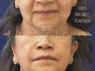 Lifting facial - 798423