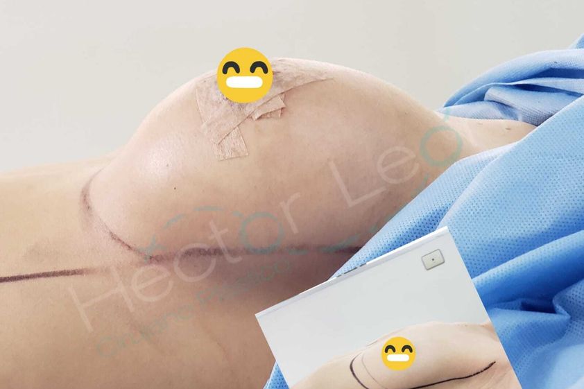 Mamoplastia de aumento antes y después - 798424