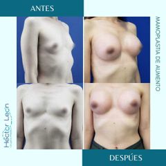 Mamoplastia de aumento - Dr. Héctor Guillermo León Higuera