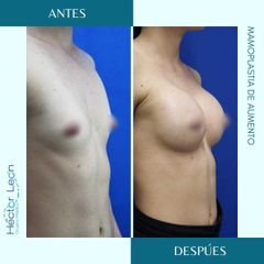 Mamoplastia de aumento - Dr. Héctor Guillermo León Higuera