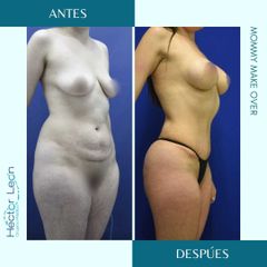 Lipoescultura - Dr. Héctor Guillermo León Higuera