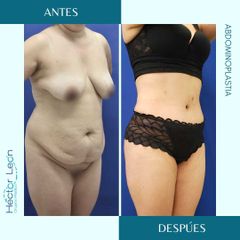 Abdominoplastia - Dr. Héctor Guillermo León Higuera