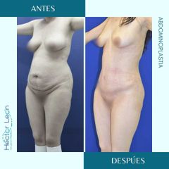 Abdominoplastia - Dr. Héctor Guillermo León Higuera