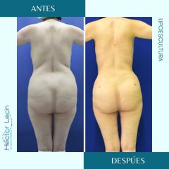 Lipoescultura - Dr. Héctor Guillermo León Higuera