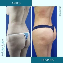 Gluteoplastia - Dr. Héctor Guillermo León Higuera