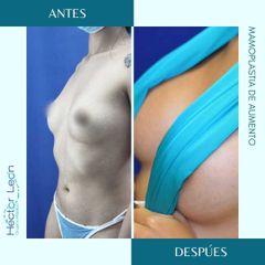 Mamoplastia de aumento - Dr. Héctor Guillermo León Higuera