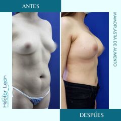 Mamoplastia de aumento - Dr. Héctor Guillermo León Higuera