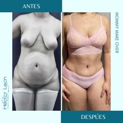 Lipoescultura - Dr. Héctor Guillermo León Higuera