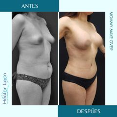Lipoescultura - Dr. Héctor Guillermo León Higuera