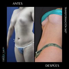 Liposucción - Dr. Héctor Guillermo León Higuera